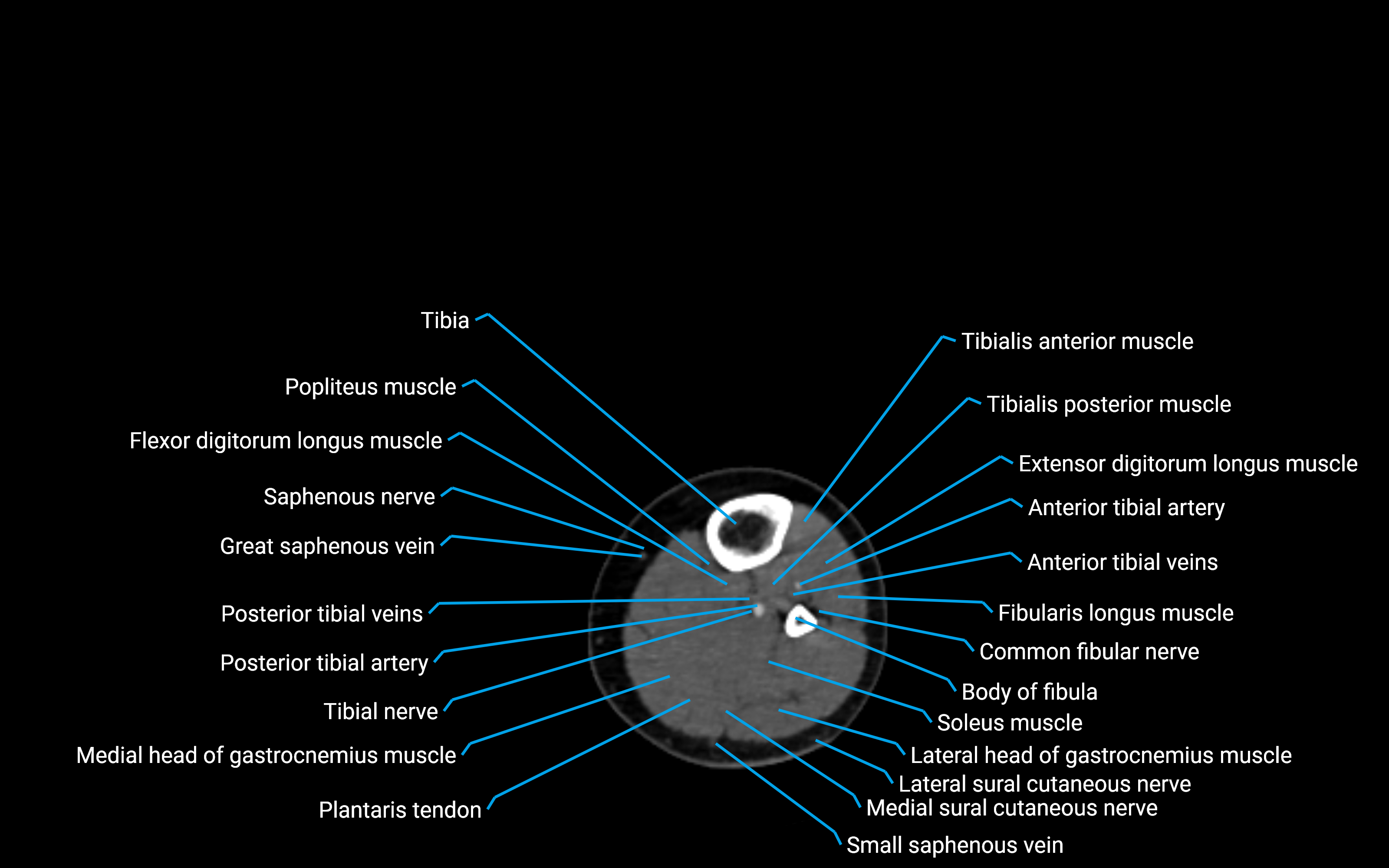 CT Lower leg axial cross sectional anatomy labelled image 105 (2).png